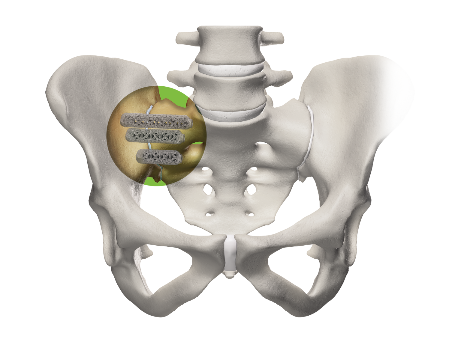 Sacroiliac Joint Fusion Restorative Pain Management
