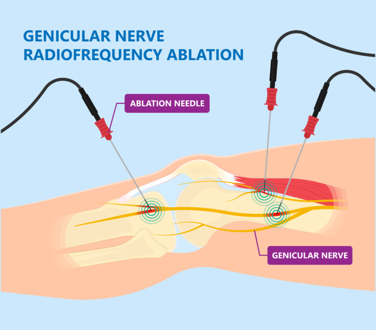 Genicular Nerve Block And Radiofrequency Ablation Restorative Pain Management