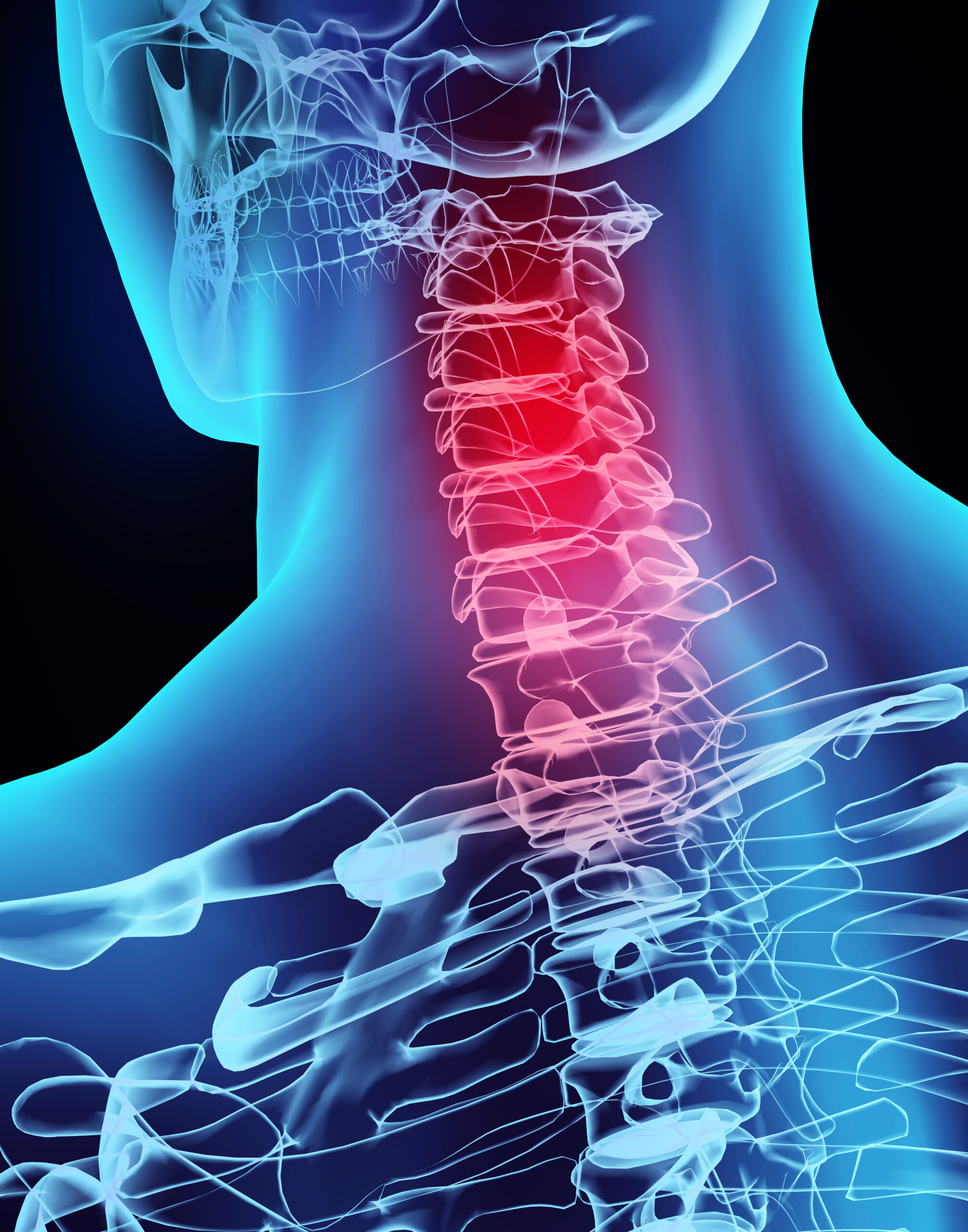 Cervical Facet Injections for Neck Pain and Whiplash - Restorative Pain ...